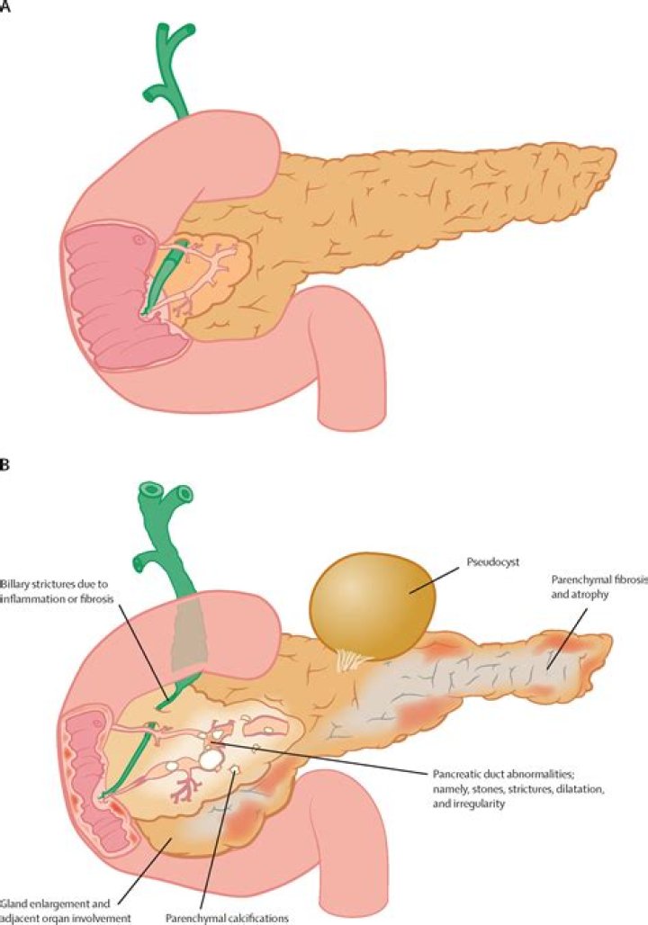 Can pancreatitis cause fluid in the lungs?