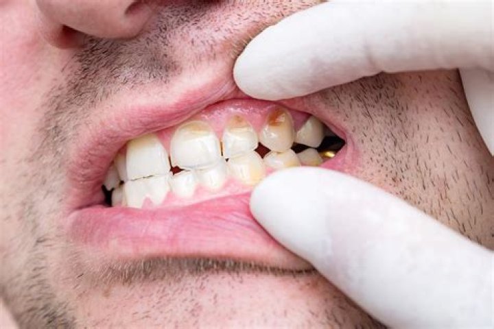 Is chipped enamel dangerous? | ContextResponse.com